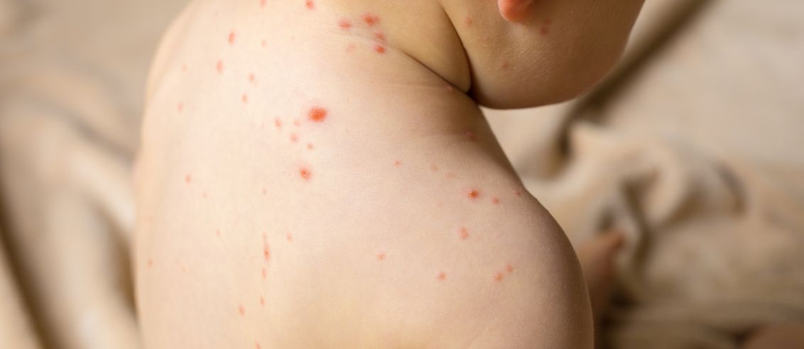 ¿Puedes contraer sarampión si estás vacunado? Respuestas a las preguntas más buscadas en Google sobre la enfermedad